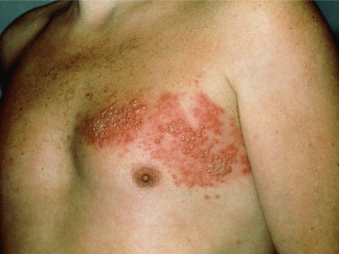 ¿Tiene 50 años o más? Ojo al herpes zóster