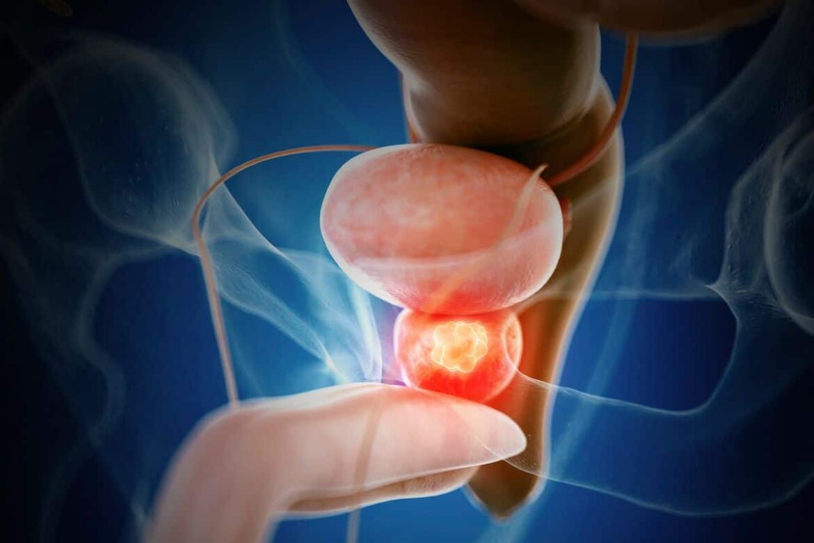 Fedefarma llama a los hombres perder miedo a los exámenes y combatir mitos del  cáncer de próstata